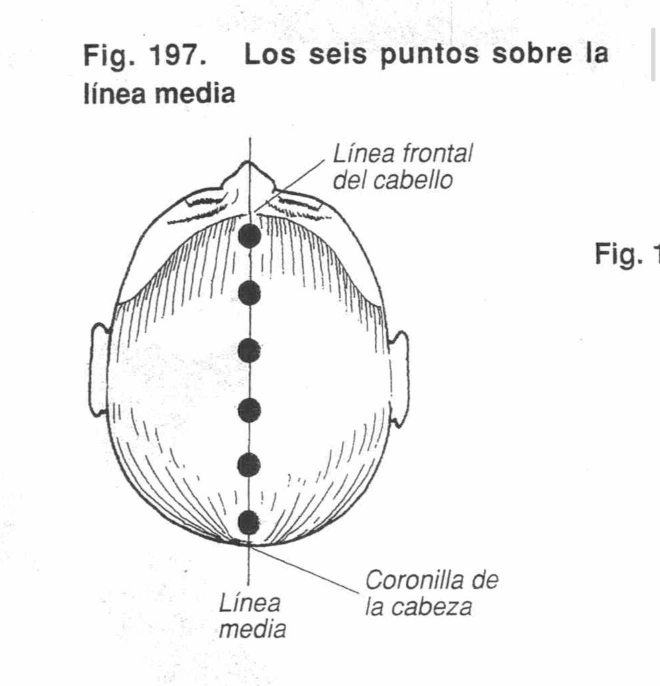 Mapa de 6 puntos en coronilla