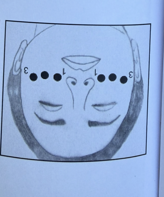 Puntos región zigomática