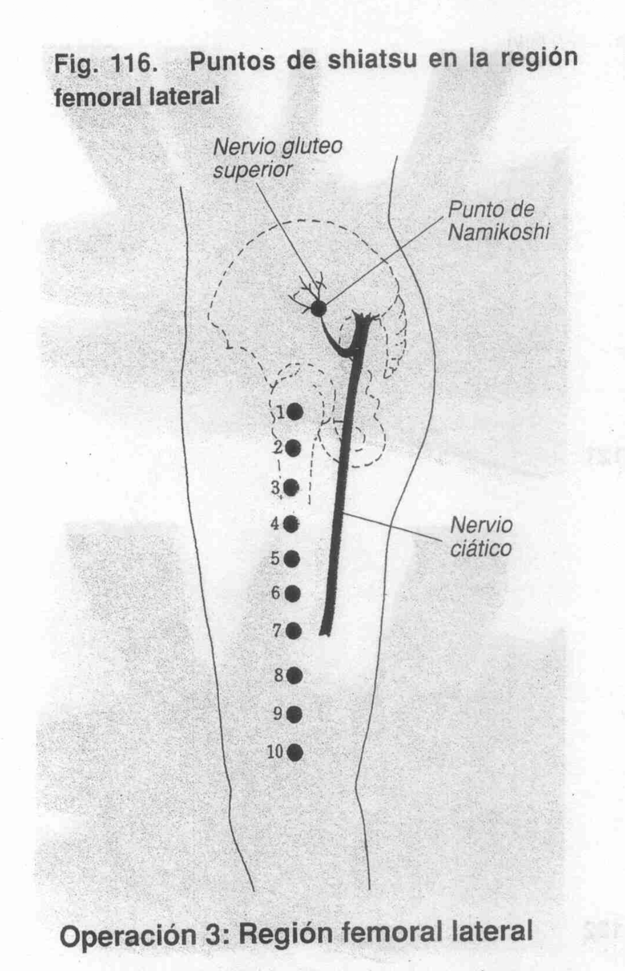 Femoral Lateral Presión