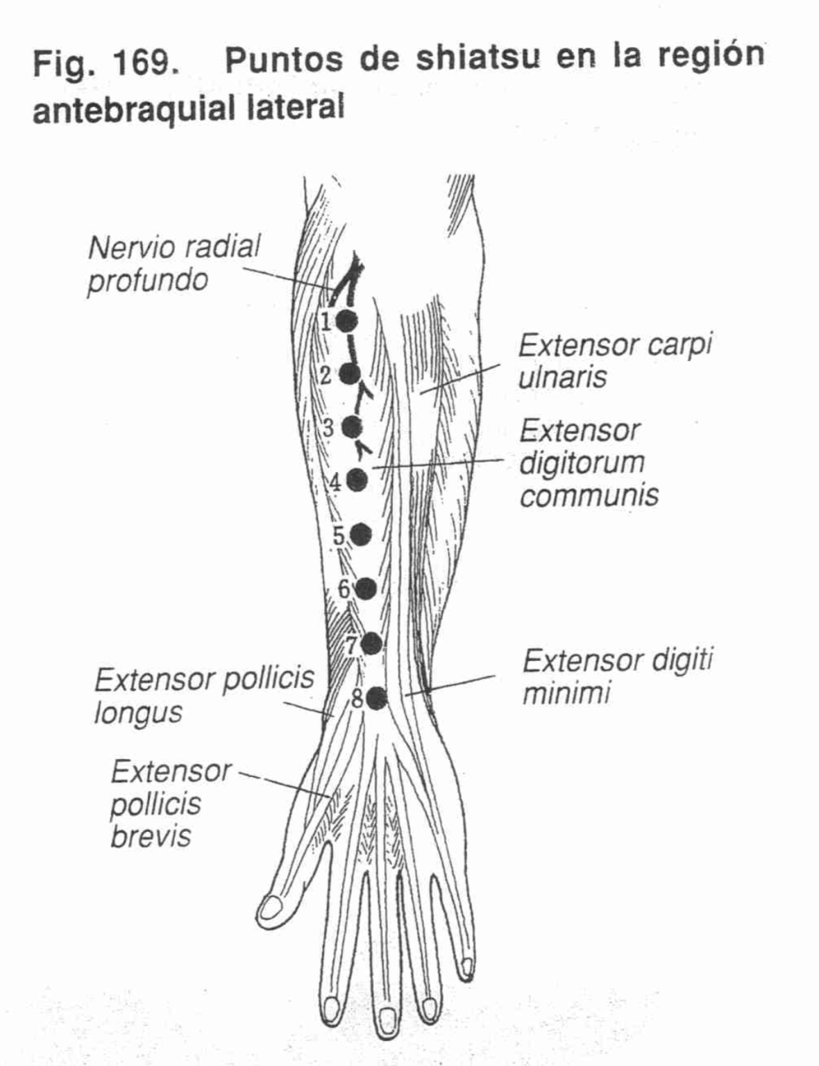 Fijación de la Palma